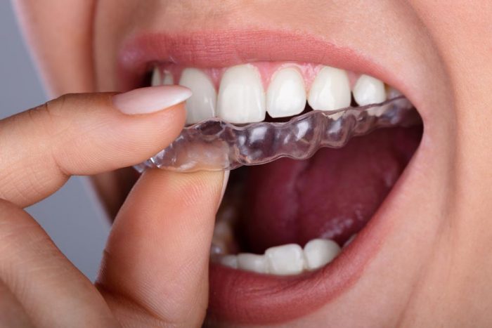 Invisalign Braces