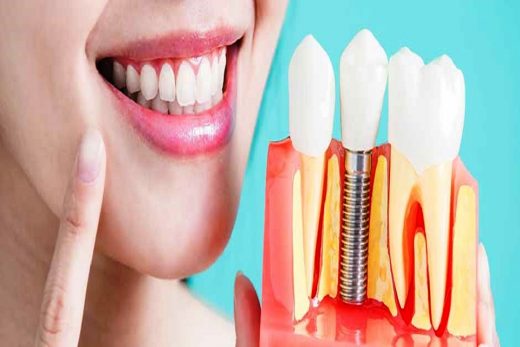 5 Important Facts About Dental Implants